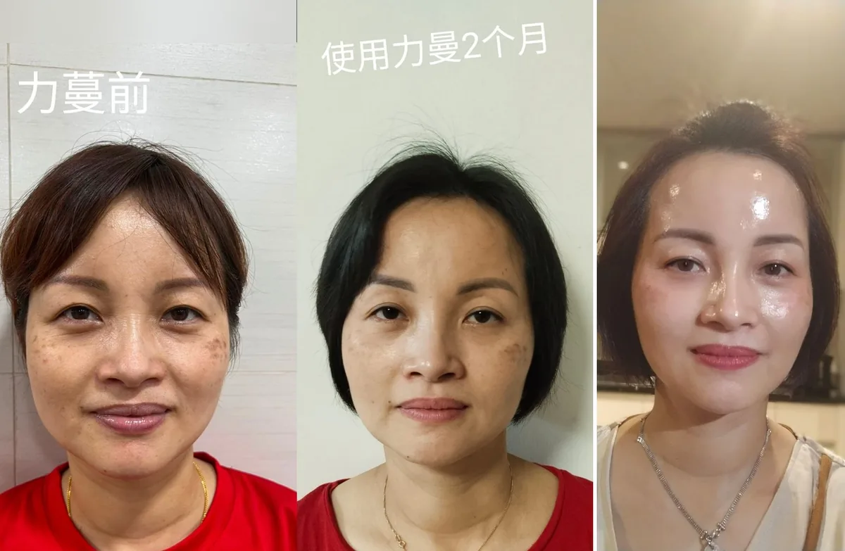 Cindy: Before starting, after two months, and a later selfie. Skin looks brighter and more even.